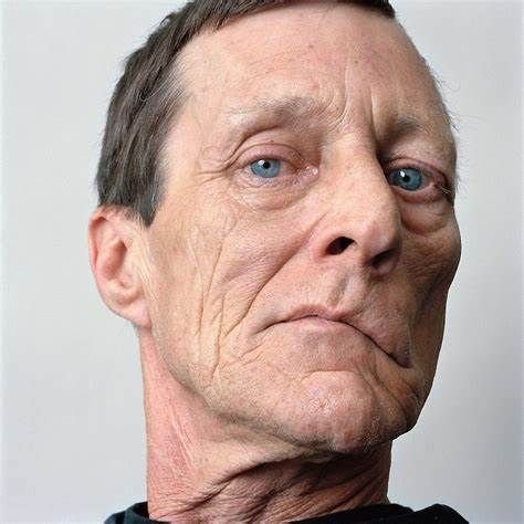 Facial Paralysis Img
